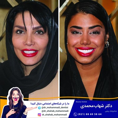 کامپوزیت ونیر طرح لبخند بدون تراش