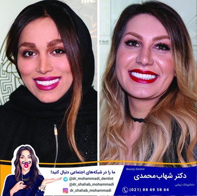 کامپوزیت ونیر طرح لبخند بدون تراش