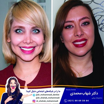 کامپوزیت ونیر طرح لبخند بدون تراش