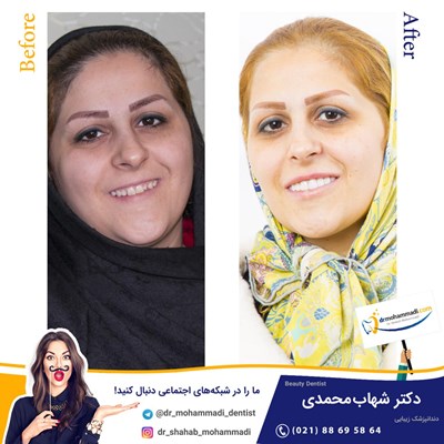 کامپوزیت بدون تراش