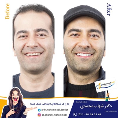 کامپوزیت بدون تراش