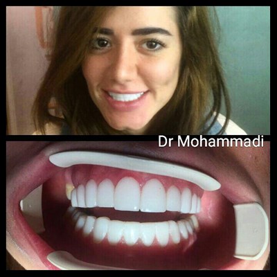 ونیر طرح لبخند