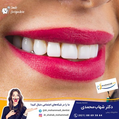 ونیر کامپوزیت بدون تراش