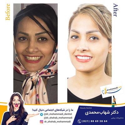 کامپوزیت ونیر طرح لبخند بدون تراش