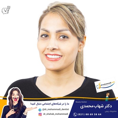 ونیر کامپوزیت بدون تراش