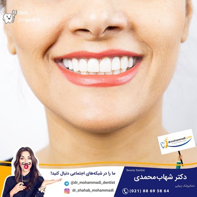 ونیر کامپوزیت بدون تراش