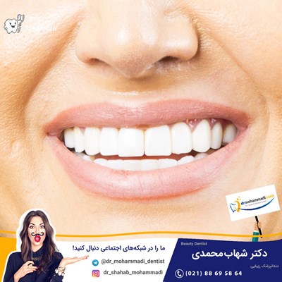 کامپوزیت ونیر طرح لبخند بدون تراش