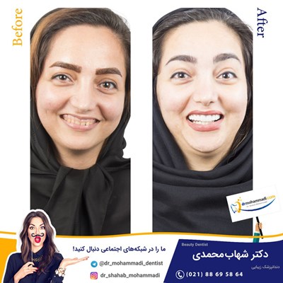 لمینیت طرح لبخند