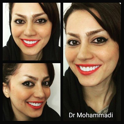 ونیر طرح لبخند