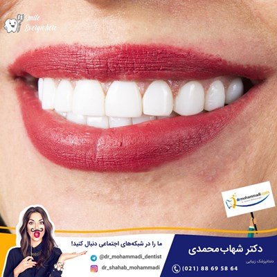 ونیر طرح لبخند