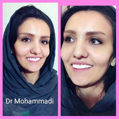 ونیر طرح لبخند