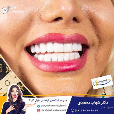کامپوزیت ونیر طرح لبخند
