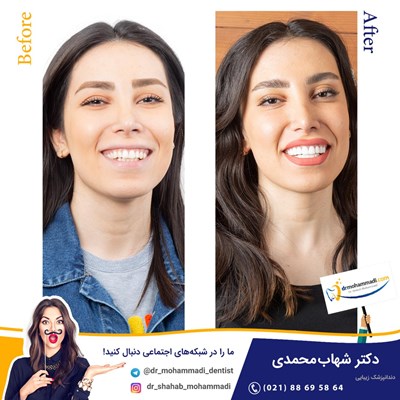 کامپوزیت ونیر طرح لبخند