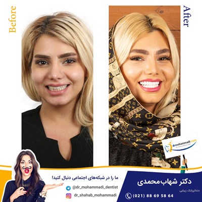 کامپوزیت ونیر طرح لبخند