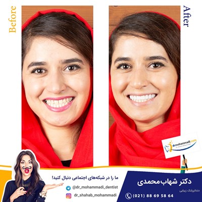 کامپوزیت ونیر طرح لبخند