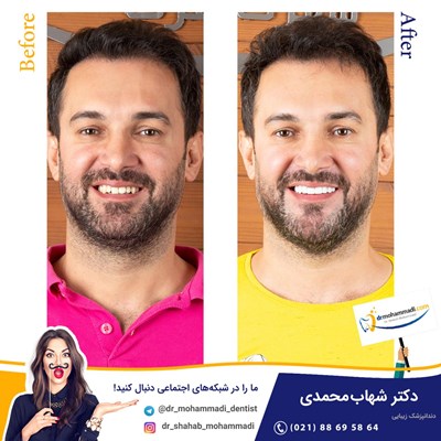 کامپوزیت ونیر طرح لبخند