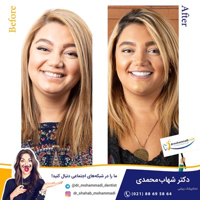 کامپوزیت ونیر طرح لبخند