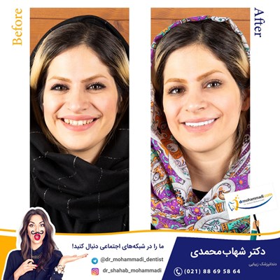 کامپوزیت ونیر طرح لبخند