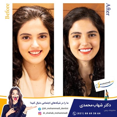 لمینت طرح لبخند