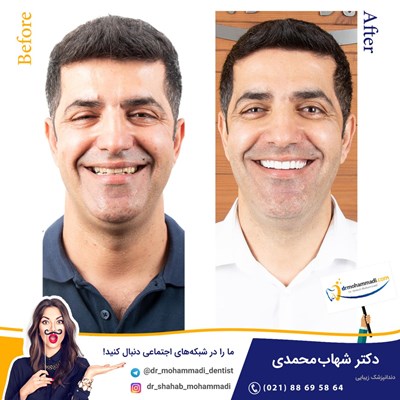 لمینیت طرح لبخند