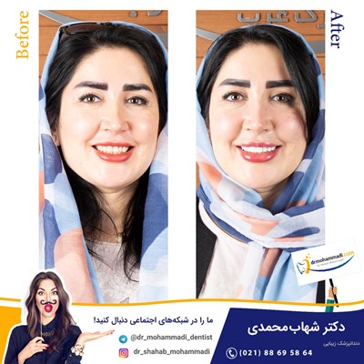 ونیر کامپوزیت طرح لبخند