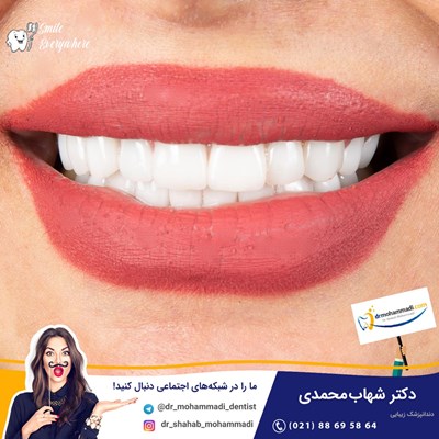 نسل جدید لمینت های نانو و دیجیتال