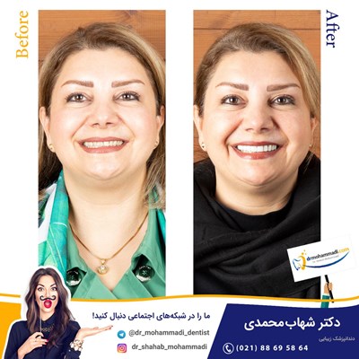 	کامپوزیت ونیر نانو طرح لبخند