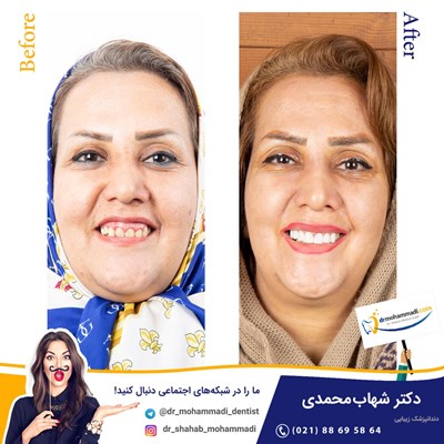 	کامپوزیت ونیر نانو طرح لبخند