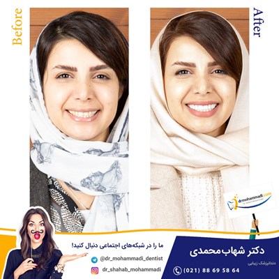 کامپوزیت ونیر نانو طرح لبخند