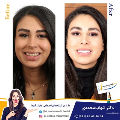 کامپوزیت ونیر نانو طرح لبخند