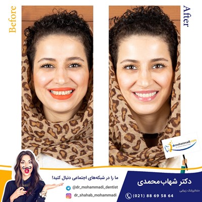 کامپوزیت ونیر نانو طرح لبخند