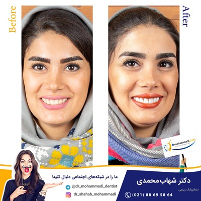 نسل جدید لمینت های نانو و دیجیتال