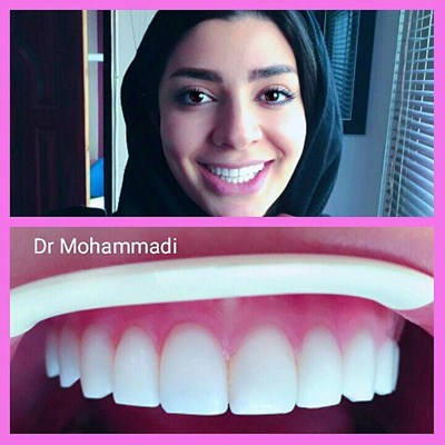 ونیر طرح لبخند