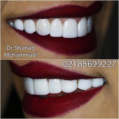 ونیر طرح لبخند