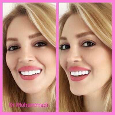 ونیر طرح لبخند