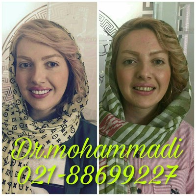 ونیر طرح لبخند