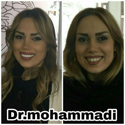 ونیر طرح لبخند