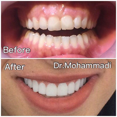 ونیر طرح لبخند