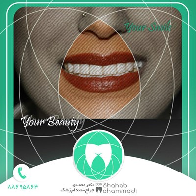 ونیر طرح لبخند