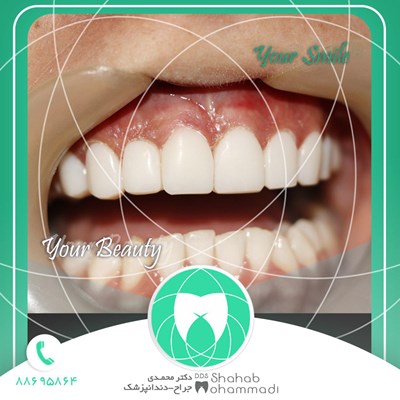 ونیر طرح لبخند