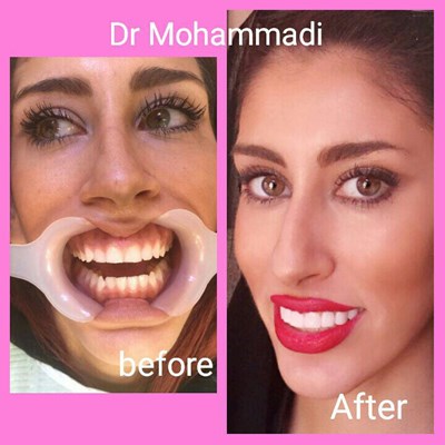 ونیر طرح لبخند