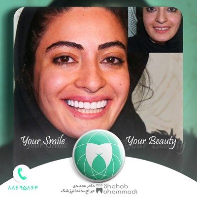 ونیر طرح لبخند