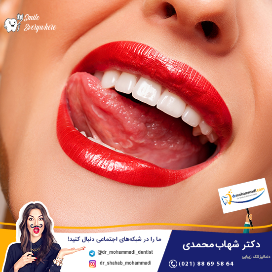 آیا بلیچینگ قبل از کامپوزیت دندان لازم است؟