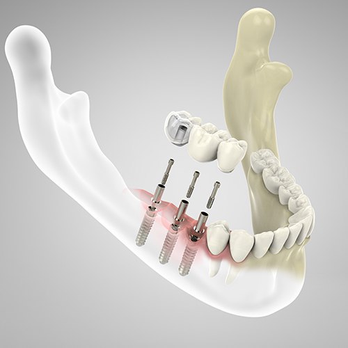 dental implant