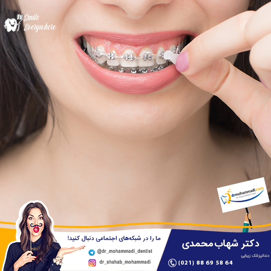 کدام روش ارتودنسی را انتخاب کنیم؟ ارتودنسی رنگی، ارتودنسی متحرک یا ارتودنسی نامرئی؟