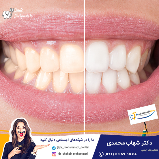بلیچینگ و سفید کردن دندان 