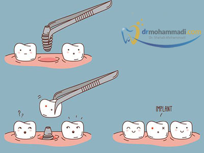 قیمت ایمپلنت کره ای