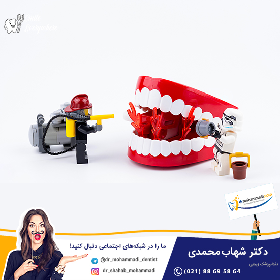 فاصله زمانی بین کشیدن دندان و ایمپلنت چقدر است