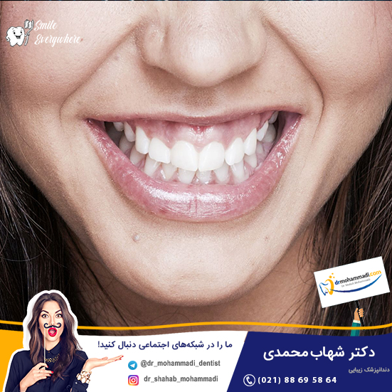 اصلاح طرح لبخند لثه ای چیست؟